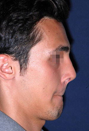 male rhinoplasty