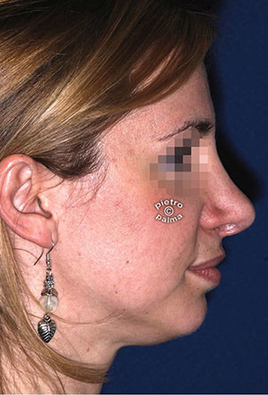 revision rhinoplasty