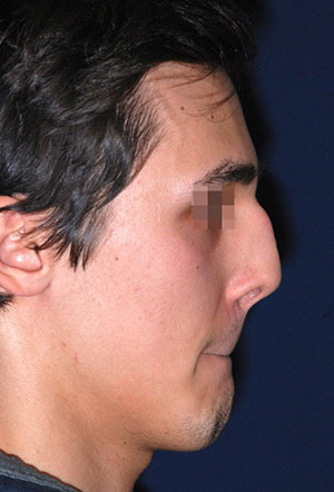 male rhinoplasty