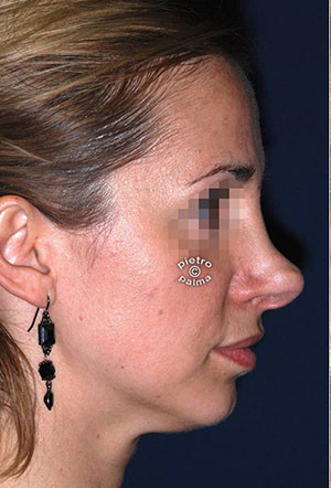 revision rhinoplasty