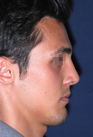 male rhinoplasty