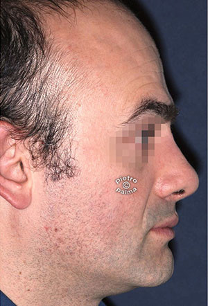 revision rhinoplasty