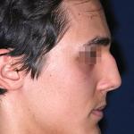 male rhinoplasty