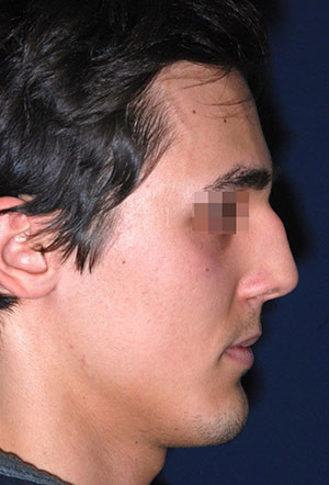 male rhinoplasty