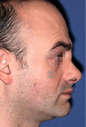 revision rhinoplasty