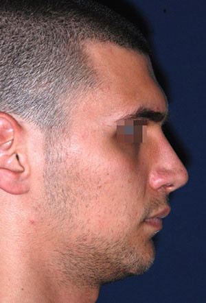 male rhinoplasty