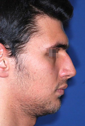 male rhinoplasty