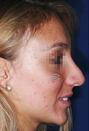 revision rhinoplasty