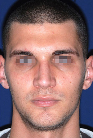 male rhinoplasty