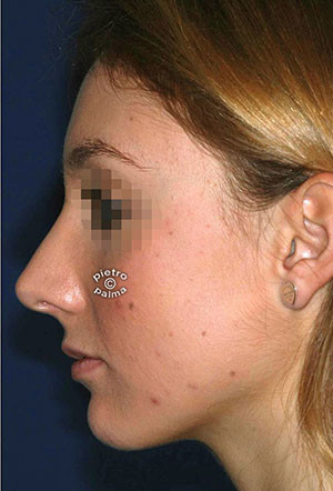 revision rhinoplasty