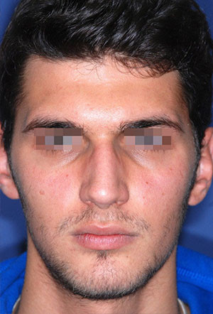 male rhinoplasty