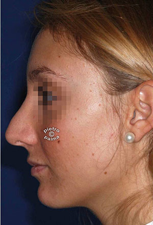 revision rhinoplasty