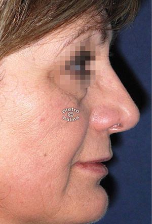 revision rhinoplasty