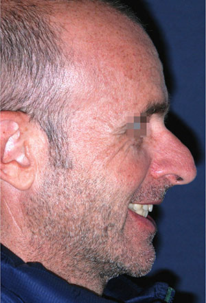 male rhinoplasty