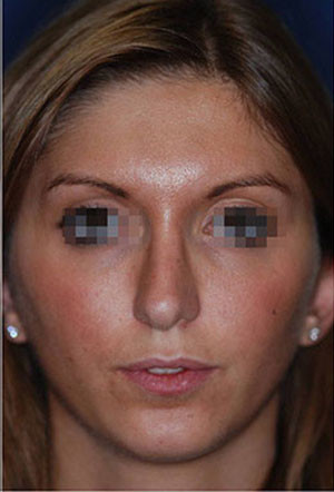 revision rhinoplasty