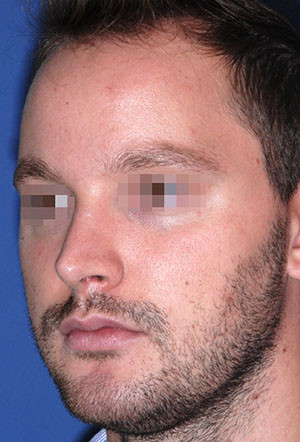 male rhinoplasty