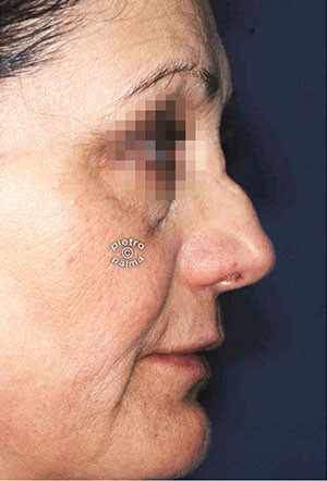 revision rhinoplasty