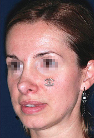 revision rhinoplasty