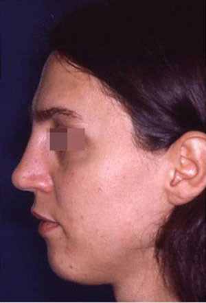 saddle nose