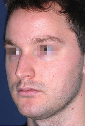 male rhinoplasty