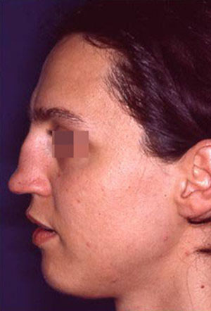 saddle nose