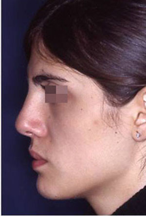 revision rhinoplasty