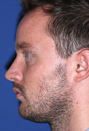 male rhinoplasty