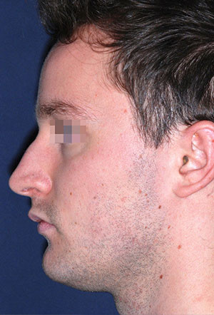 male rhinoplasty