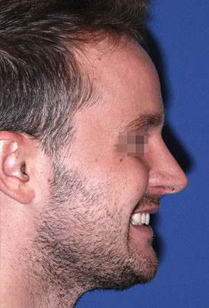 male rhinoplasty