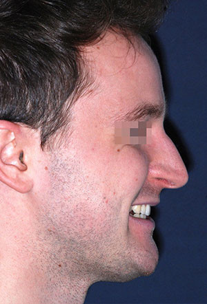 male rhinoplasty