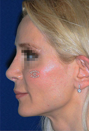 revision rhinoplasty