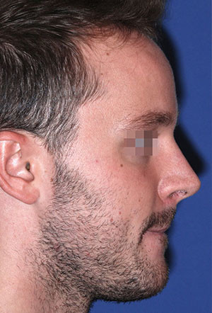 male rhinoplasty