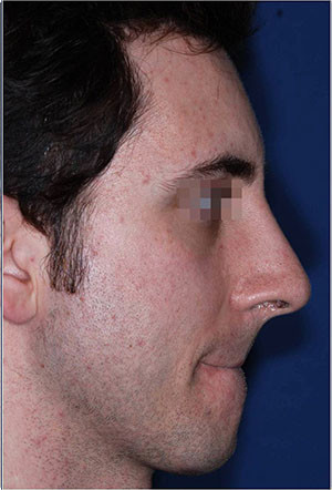 nasal hump