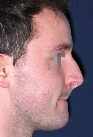 male rhinoplasty