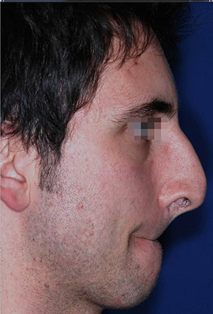 nasal hump